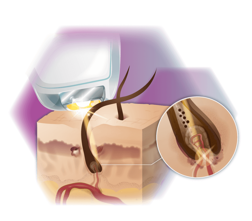 Infografik Diodenlaser