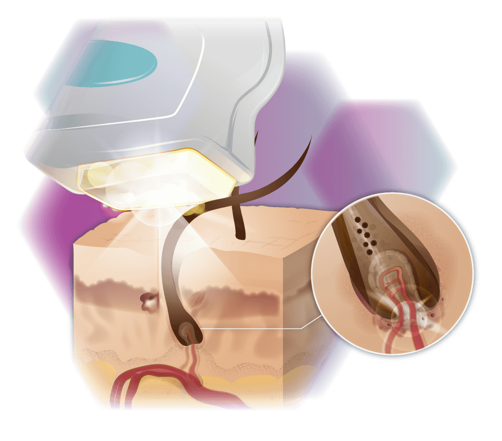 Illustration SHR Wirkungsweise Infografik